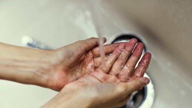 أخطاء شائعة في علاج الحروق ابتعد عنها