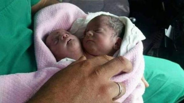 بالصور: ولادة طفلة برأسين في ريف ادلب 