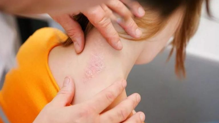 الصدفية .. كيف نفرقها عن الأكزيما ونصائح للعلاج وتخفيف حدتها