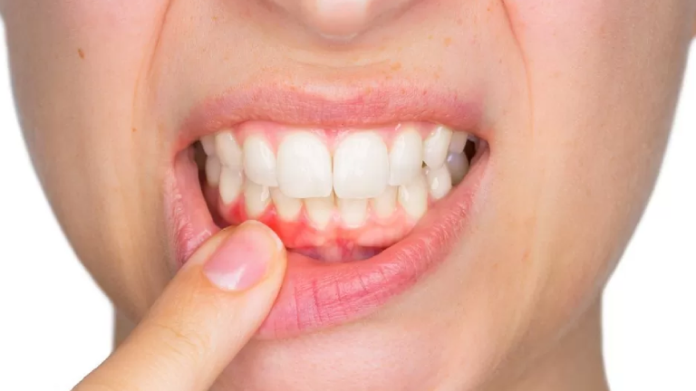 تبييض الأسنان بوسائل آمنة وصحية .. وخرافات ابتعد عنها 