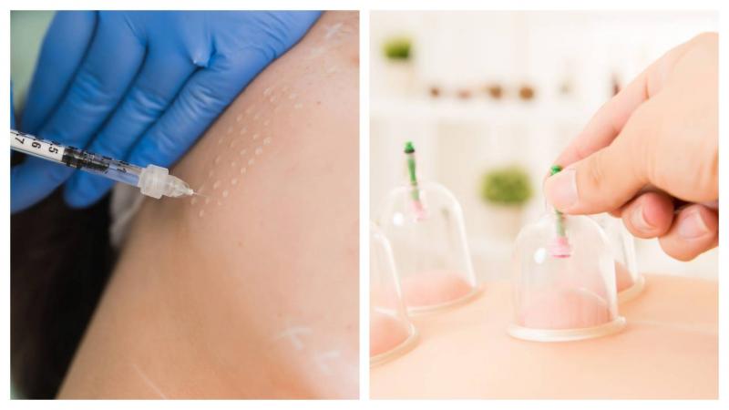 تعرف أكثر إلى الطب التكميلي.. الحجامة والميزوثيرابي